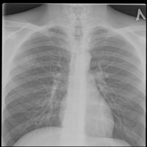 TB Positive X-ray
